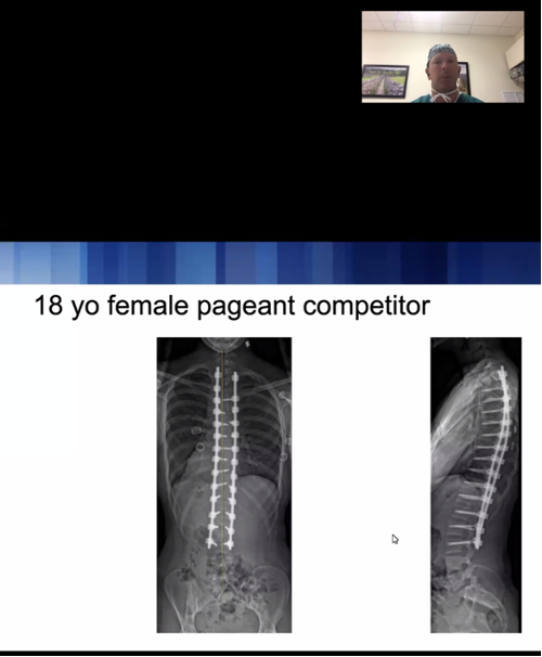 One of the great things @DukeSpine is that we have a great Pediatric Spine Team. Recently, during our weekly fellow didactic session, Dr. Robert Lark discussed surgical management of adolescent idiopathic scoliosis and presented some amazing cases to our fellows. @DukeOrtho