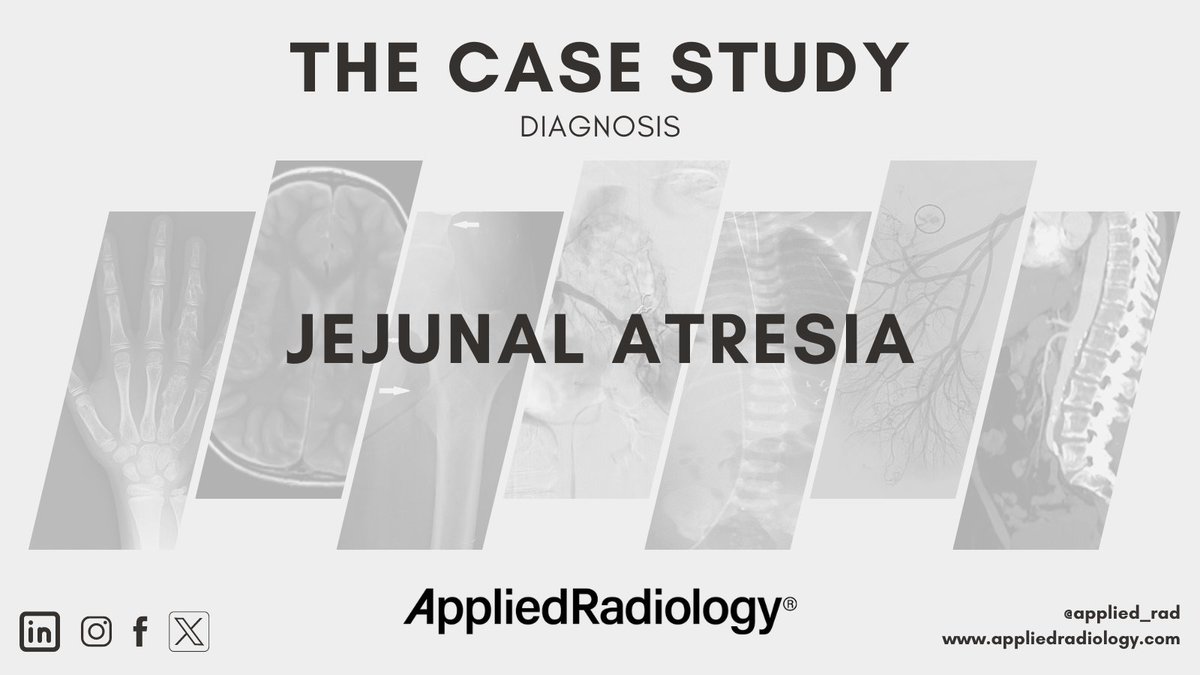 🩻 Case Study of the Week! Jejunal atresia See all the case details, more images, and diagnosis ➡️ bit.ly/3Uo2HN0 #RadEd #Radiology #CaseOfTheWeek #RadRes #CaseStudy