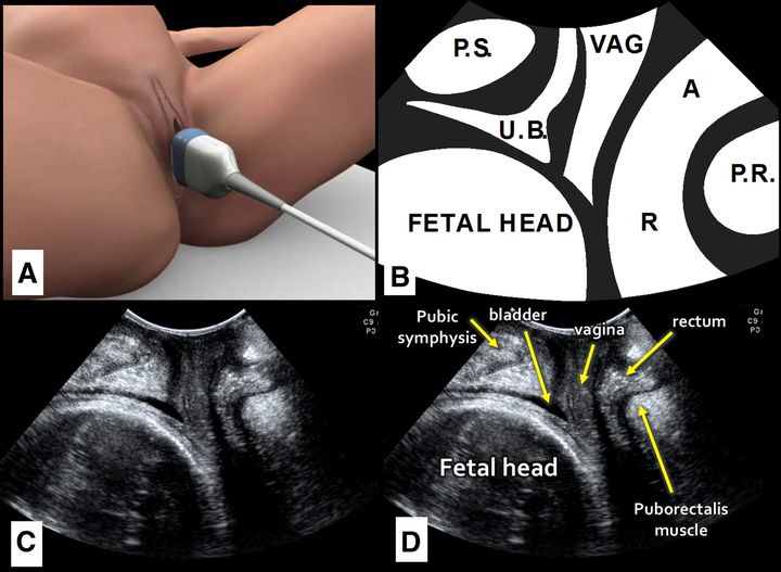 AJOG Expert Review in Labor: Soft-tissue dystocia due to paradoxical contraction of the levator ani as a cause of prolonged second stage: concept, diagnosis, and potential treatment - Transperineal ultrasound for pelvic floor assessment ow.ly/7VKb50R5iaS