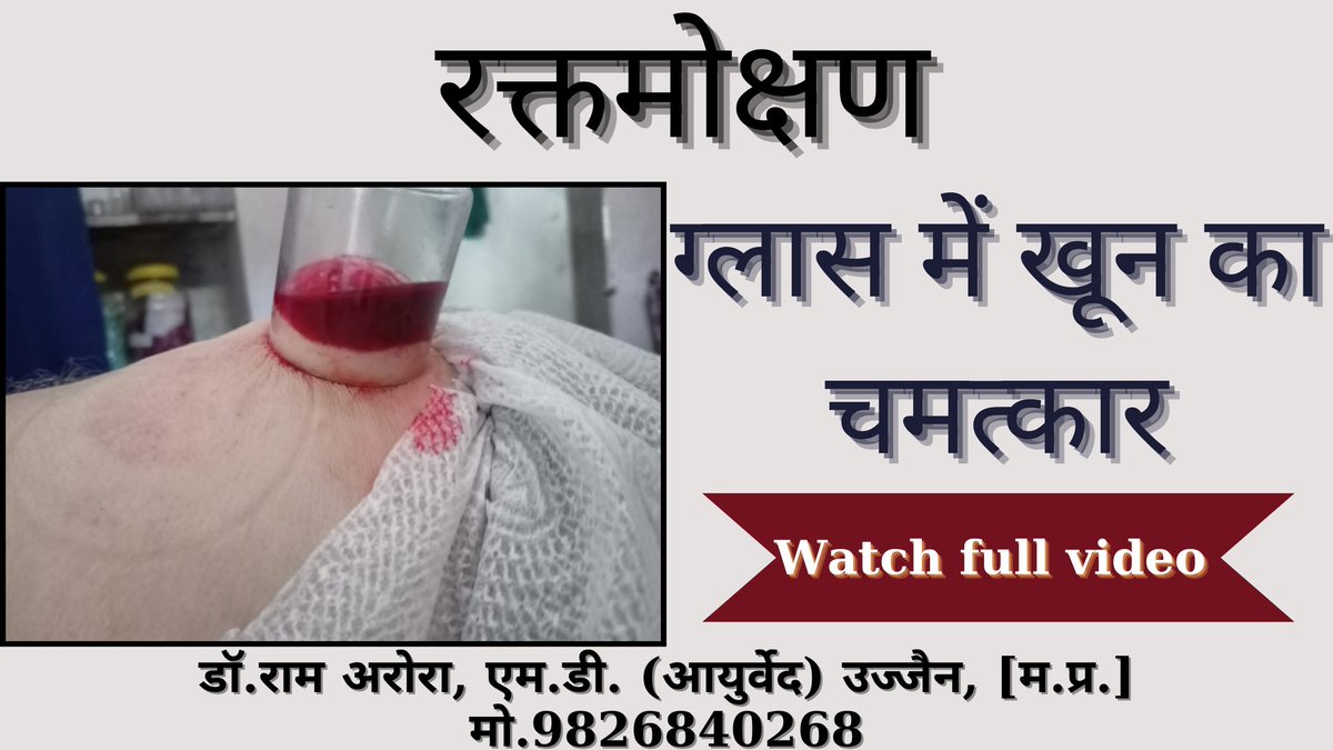 GSewa's tweet photo. *Raktmokshan - Blood letting* 
    *एक ग्लासों में खून का चमत्कार* 
 यह आयुर्वेद की वह चमत्कारिक प्रक्रिया ह�� जो जोड़ों का दर्द, कमर दर्द, सायटिका, बालों का झड़ना एवं त्वचा विकार (Skin disease) आदि कई समस्याओं हेतु एक चमत्कारिक चिकित्सा है * *https://t.co/6jX53zMK8c

#Raktmokshan https://t.co/cUP0oUCbNu