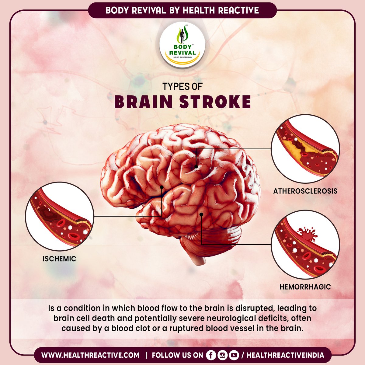 Explore various types of brain strokes: Ischemic, Hemorrhagic, and Transient Ischemic Attack (TIA). Recognizing symptoms and seeking prompt medical help is crucial for recovery.

For More Follow Us
healthreactive.com

#immunebooster #HealthReactive #bodyrevival #DrMunirKhan…