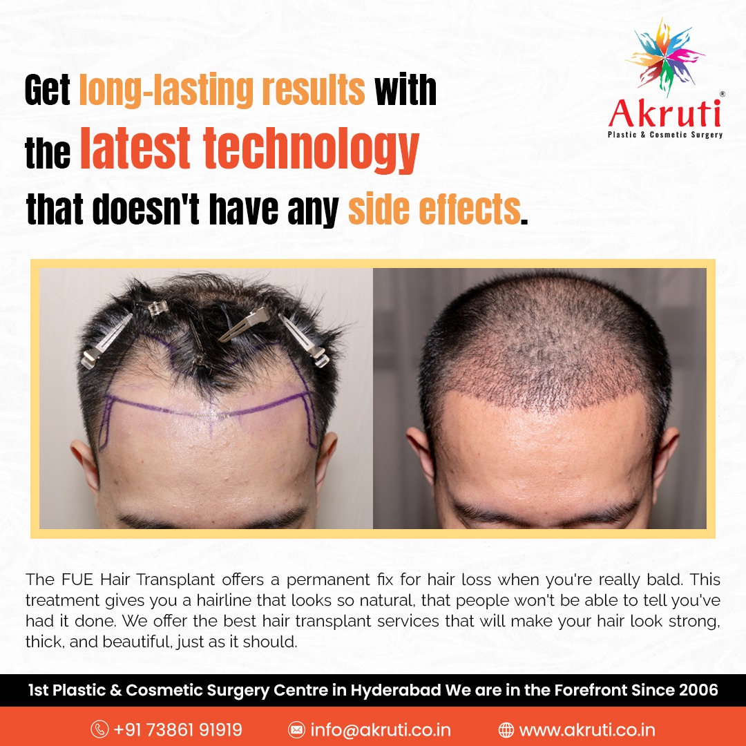 Get long-lasting results with latest technology that doesn’t have any side effects.

#fuehairtransplant #hairtransplant #fue #hairloss  #hair #hairrestoration #haartransplantation #hairtransplantsurger #plasticsurgery #implantecapilar #hairclinic #haircare #akruti