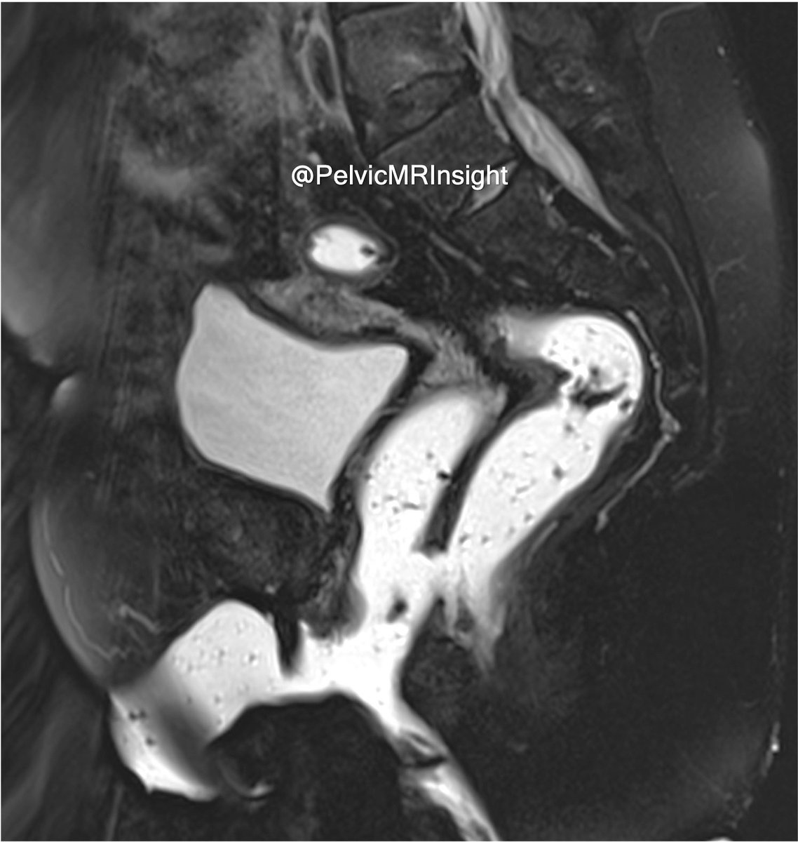 Female patient with fecal incontinence, history of 6 normal vaginal deliveries. What type of fistula is depicted on this sagittal MRI?

A.Trans-sphincteric fistula
B.Supralevator fistula
C.Extra-sphincteric fistula
D.Ano-recto vaginal fistula #Pelvicfloor #Radiology #MRI #Radres