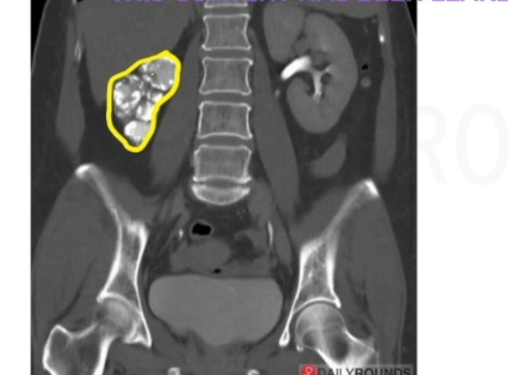 putty Kidney on Radiography
spot the diagnosis?

#NEETUG #NEET #USMLE #MedX #medicine #MEDebate #b0105