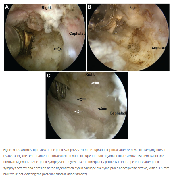 Another option for recalcitrant #osteitispubis? This Turkish study reports on 10 soccer players treated with arthroscopic debridement with excellent outcomes! #OrthoTwitter Read the results #OpenAccess here! ow.ly/sCz150Rjp6L