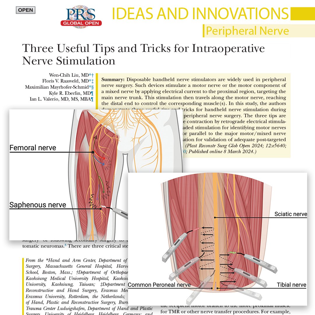 How to identify the motor branch of muscle efficiently, especially in a revisional amputation full of fibrotic tissue and atrophic muscle? Read, 'Three Useful Tips and Tricks for Intraoperative Nerve Stimulation,' to find out: bit.ly/3TricksNerve
