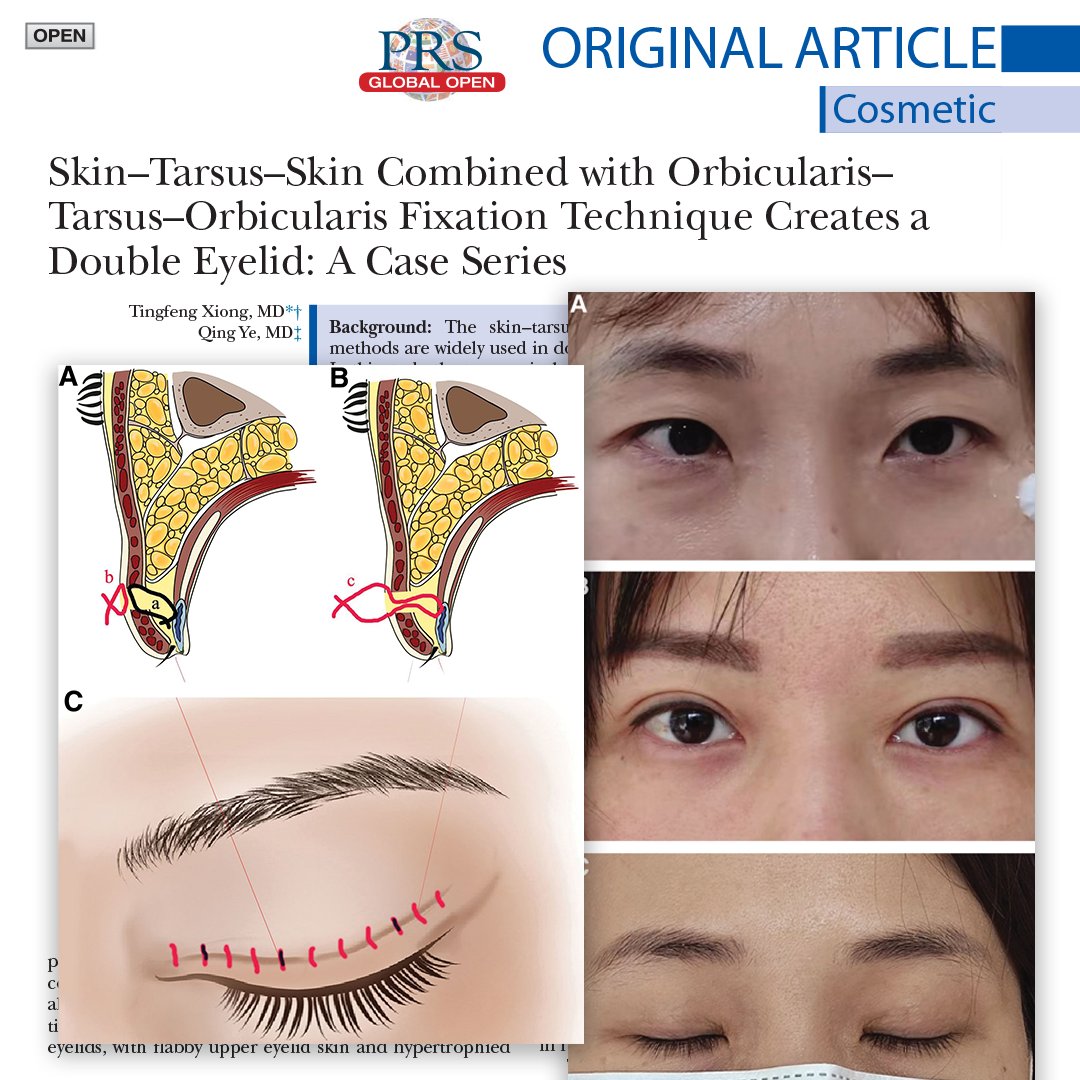 In this #PRSGlobalOpen study combined the two surgical procedures of skin–tarsus–skin & orbicularis–tarsus–orbicularis to develop a new suture method that produces an outcome that is more like the natural physiological structure of the double eyelid. bit.ly/SkinTarsusSkin