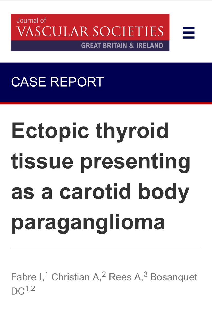 Ismay Fabre (@ismayfabre) on Twitter photo Case Report on an ectopic thyroid presenting as a carotid body paraganglioma now online at
jvsgbi.com/ectopic-thyroi…
<a href="/davebosanquet/">Dave Bosanquet</a> <a href="/VSjournalGBI/">Journal of Vascular Societies GB&I</a> Case Report on an ectopic thyroid presenting as a carotid body paraganglioma now online at
jvsgbi.com/ectopic-thyroi…
<a href="/davebosanquet/">Dave Bosanquet</a> <a href="/VSjournalGBI/">Journal of Vascular Societies GB&I</a>