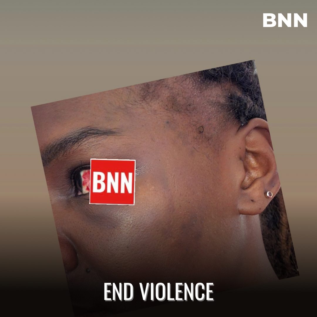 Content creator, Lornah Mweu, alias Mamakebobo shares pictures with a swollen red eye and swollen feet and arms. #bnnpremium for more images. What happened to her? #endviolence #mamakebobo SUBSCRIBE TO BNN PREMIUM- t.me/bnnkenya/47665