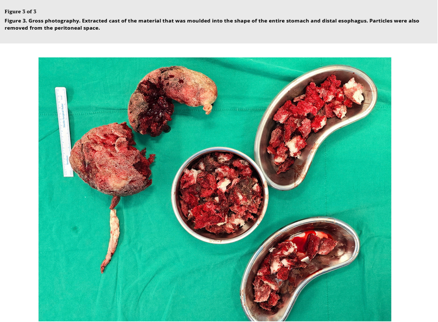 A 45-year-old man presented to the emergency department with abdominal pain after deliberate ingestion of polyurethane foam. Moulded casts of the stomach and esophagus were extracted. tandfonline.com/doi/full/10.10…