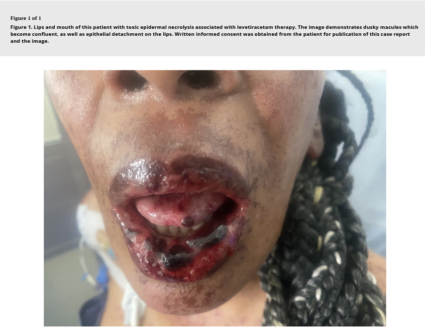 A 47-year-old woman was found to have toxic epidermal necrolysis associated with the use of levetiracetam. tandfonline.com/doi/full/10.10…