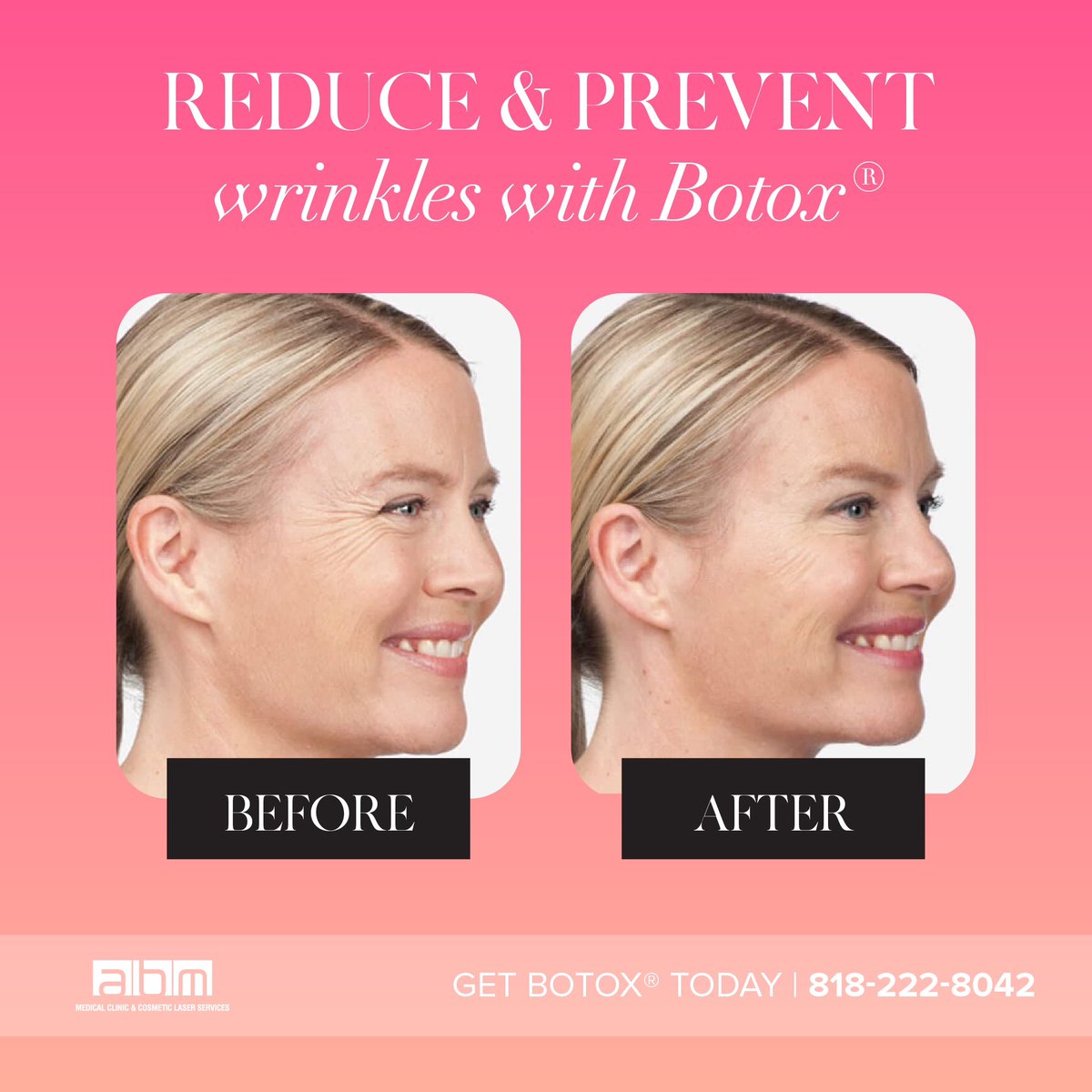 Botox in LA all injections performed by doctors ABMmedical.com