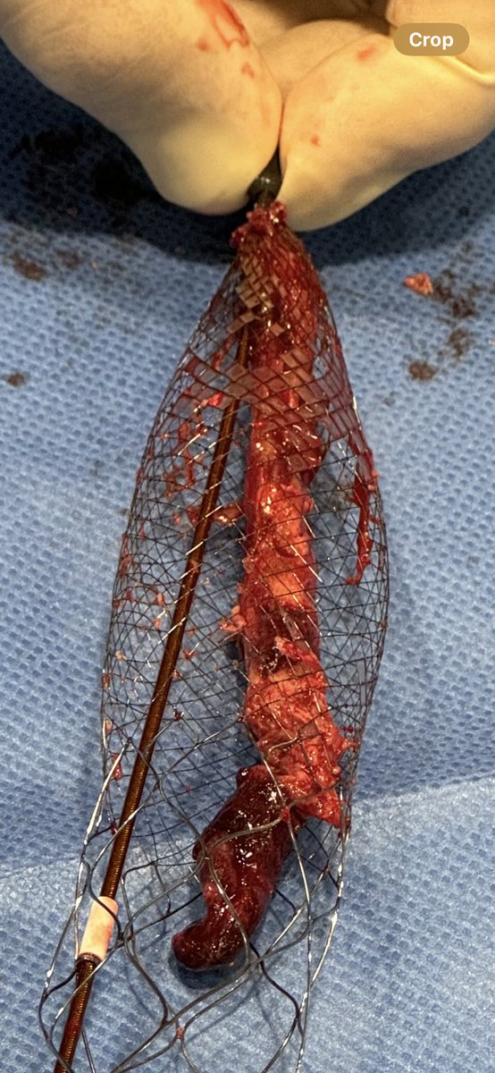 A young patient on birth control with a sizable clot extending from the inferior vena cava down to the right iliac vein. A case that would have been very challenging 5 years ago but with new tech (Clotriever XL/ Protrieve) is more than doable.