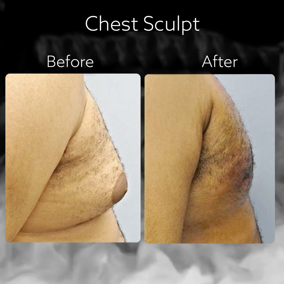 Up to $500 off ChestSculpt! 

 #spaday #spa #medicalaesthetics #medispa #bostonlaser ⁠#botoxboston #fillersboston #lipfiller #medspa #losingfat #fatloss #dieting #exercising #sculpting #chestsculpt #chestsculpting #manboobs