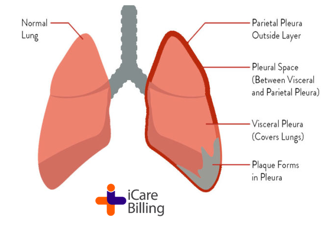 Mesothelioma is a cancer that forms in the thin tissue that lines many of your internal organs. This thin tissue is called the mesothelium. The most common kind of mesothelioma forms in tissue around the lungs, called the pleura. #icarebilling, an American #HealthcareIT company