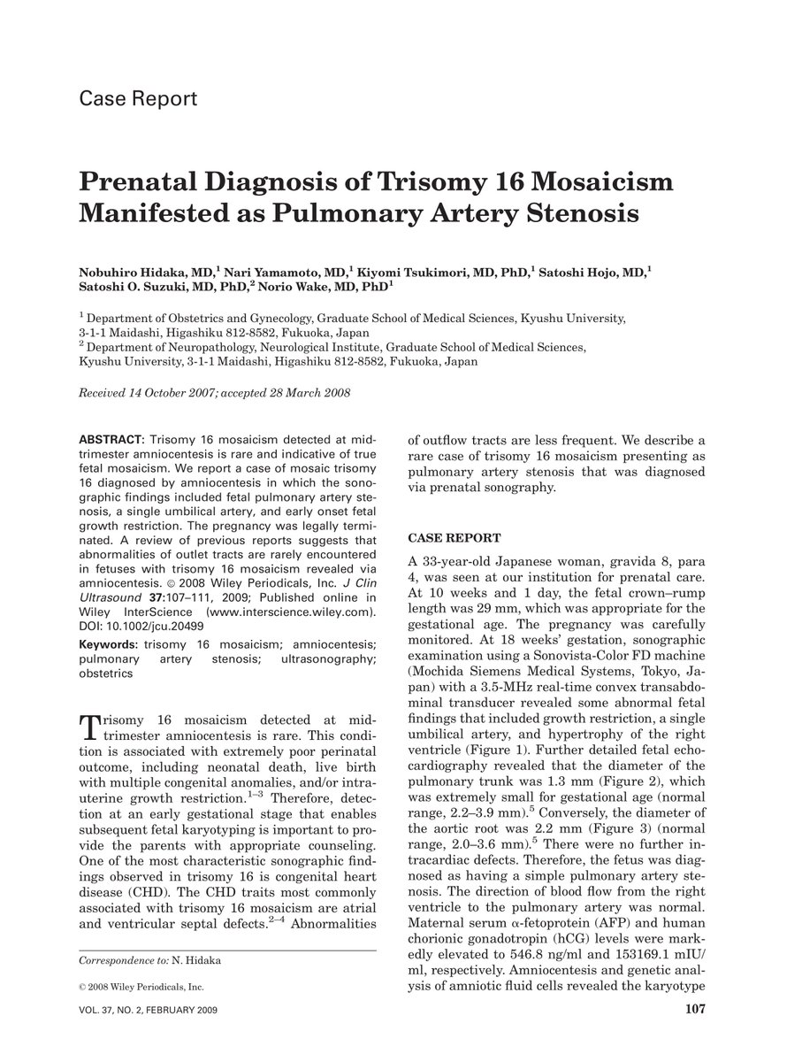 Prenatal diagnosis of trisomy 16 mosaicism manifested as pulmonary artery stenosis eurekamag.com/research/055/1…