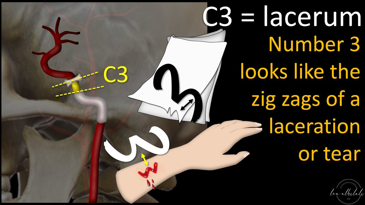 5/C3 is the lacerum segment—from above foramen lacerum to petrolingual ligament. It’s easy to remember b/c lacerum comes from the Latin word for torn (b/c foramen lacerum is irregular like a tear or laceration) Number 3 zig zags like a laceration or torn edge, so C3 = lacerum