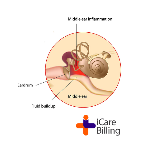Otitis media is an infection of the middle ear. It causes inflammation and a build-up of fluid behind the eardrum. The fluid in the ear even after an infection clears up. If it's there for longer than 3 months, more treatment might be needed. #icarebilling, the best #RCM Company