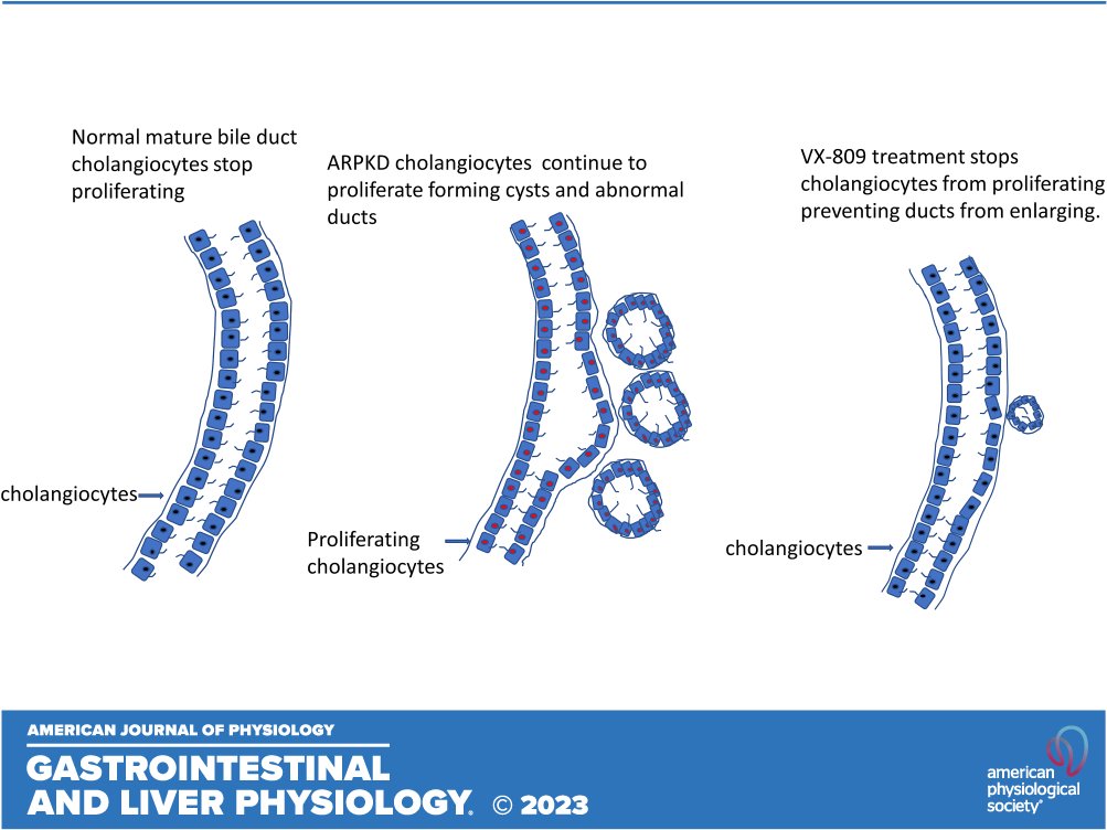 🔓#SuggestedRead  'Ameliorating #LiverDisease in an autosomal recessive #PolycysticKidneyDisease mouse model' by Murali K. Yanda et al.

Free to Read👉 ow.ly/Ew7E50RhxRn

#BiliaryDucts #CFTR #fibrocystin #polyductin #Polcystin2 #HeatShockProtein