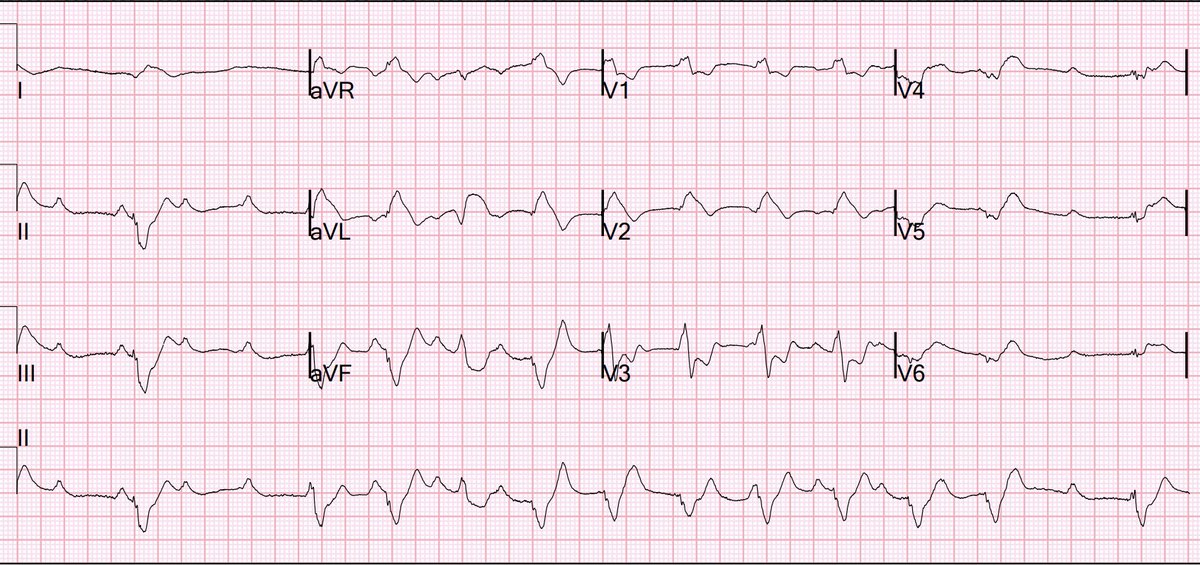 Sudden shock with a Nasty looking ECG. What is it?

hqmeded-ecg.blogspot.com/2024/05/sudden…

Prehospital, then ED ECGs