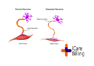 Motor neurone disease (MND) is a rare condition that progressively damages parts of the nervous system. This leads to muscle weakness, often with visible wasting. Amyotrophic lateral sclerosis (ALS) is the most common form of MND. #icarebilling, an American #HealthcareIT company
