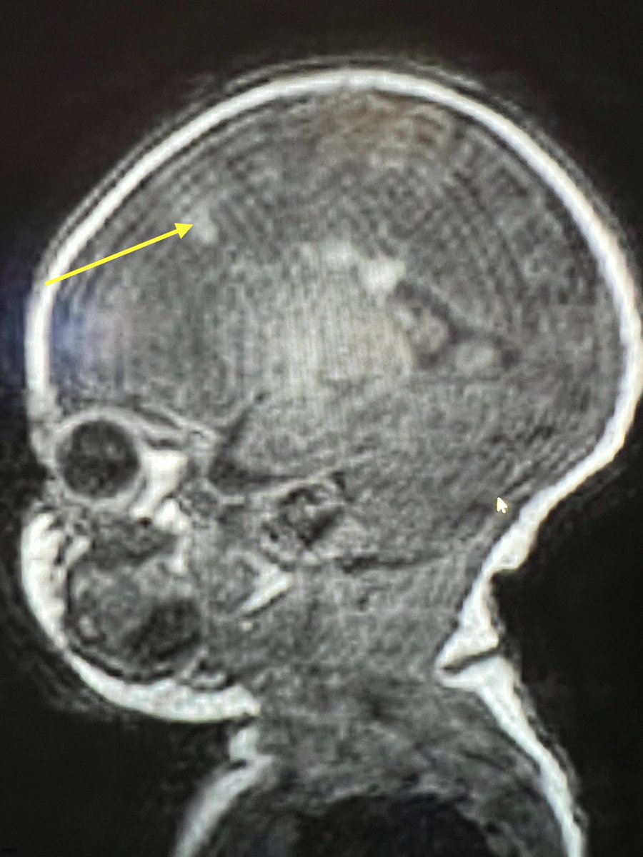 Tip of the day 💡: T1, the key sequence in neonates to detect tubers of TS. Learn to see through artefacts this weekend- welcome to the real world. Pictures are not always pristine, but your detection skills can be. Picked up the subependymal nodules too?