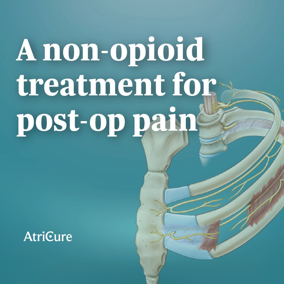 Cryo Nerve Block provides non-opioid pain relief, numbing the surgical site for up to 3 months. 

cryoNB is a crucial addition to pain-management care as options can become limited post-op. 

Learn more about #cryoNB: okt.to/5NXuSR 
#PatientsFirst #CardioTwitter