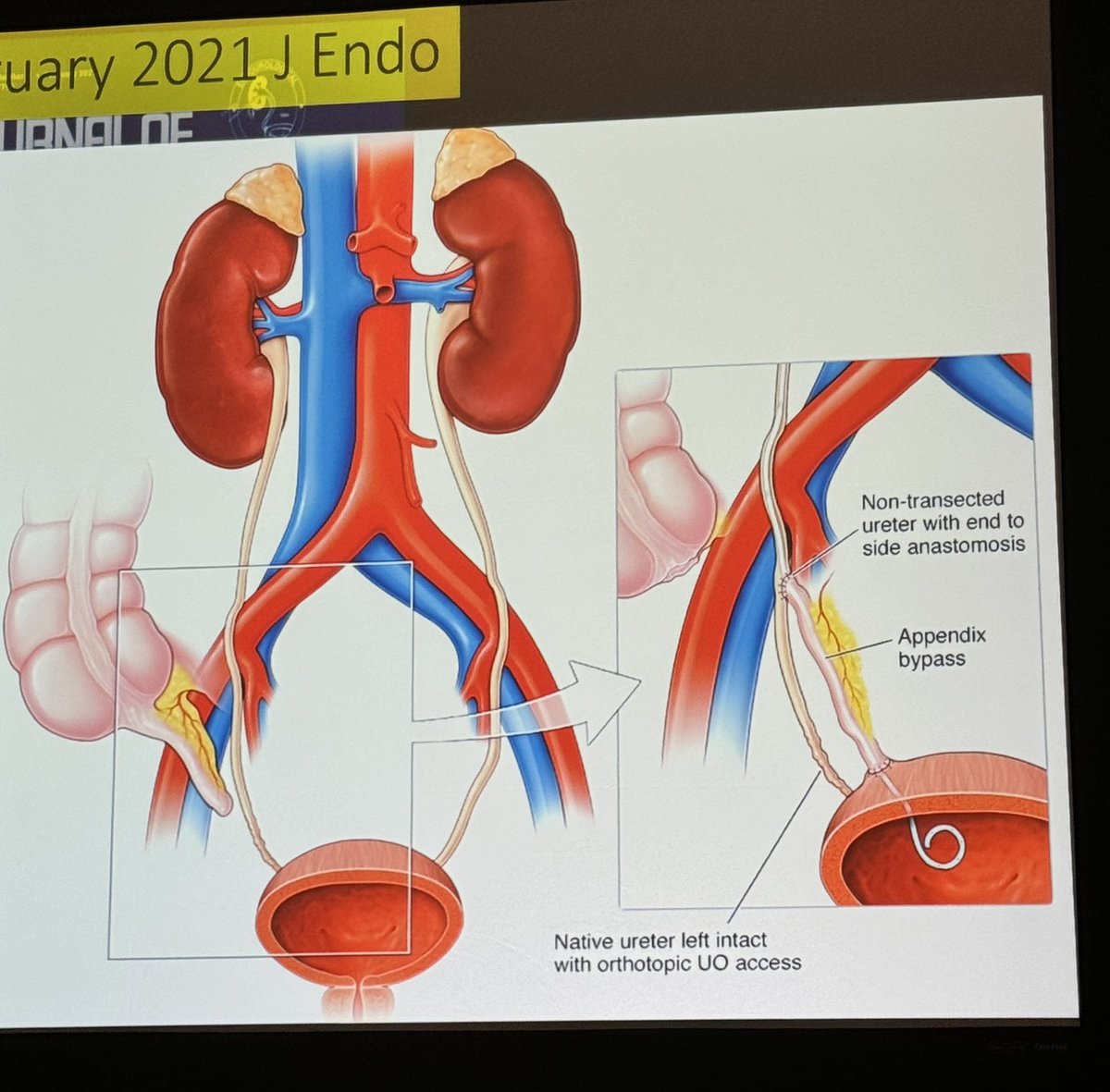 Tiago Borelli Bovo (@uroborelli) on Twitter photo Outstanding course on upper tract robotic reconstruction with breaking new concepts by <a href="/md_eun/">Daniel D Eun MD</a> <a href="/lee_c_zhao/">Lee Zhao</a> <a href="/mdstifelman/">Michael Stifelman</a> at #AUA2024 Outstanding course on upper tract robotic reconstruction with breaking new concepts by <a href="/md_eun/">Daniel D Eun MD</a> <a href="/lee_c_zhao/">Lee Zhao</a> <a href="/mdstifelman/">Michael Stifelman</a> at #AUA2024