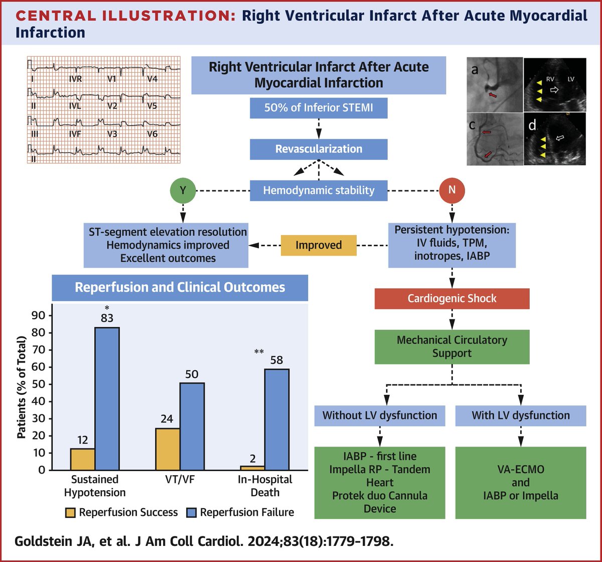 Do you know when to use pharmacologic or mechanical support in RV infarction? Get the latest in this week’s #JACC focus seminar: bit.ly/3y6mZmP

#cvMI #cvAMI #CariogenicShock #CardioX