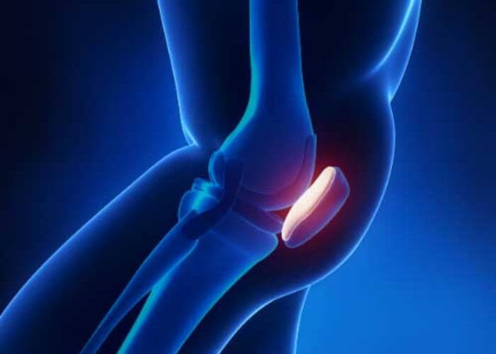 Patella dislocation can be complex, but there's hope for recovery! Dr. Patel discusses both non-surgical and surgical treatment options for patients dealing with this knee injury. Get the expert guidance you need for optimal healing. medilink.us/ukw8  #kneeedislocation