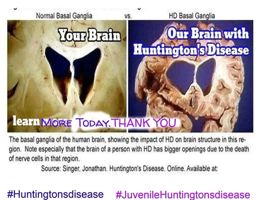 🧠🔬 #CureHD #Jhdkids #huntingtonsdisease #blueandpurple #wehaveaface #HDresearchselfie
Everyday Is #Huntingtonsdisease Awareness
Get ...Involved with your RT
My Family Thanks You
#LetsTalkABoutHD
#huntingtondisease
#juvenilehuntingtonsdisease
#ClinicalResearch #HDCommunity