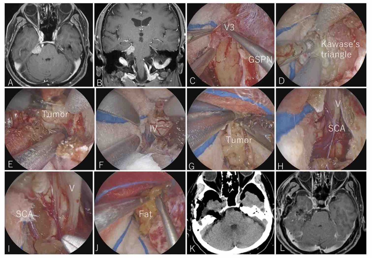 #OnlineFirst: Purely endoscopic subtemporal keyhole anterior transpetrosal approach to access the petrous apex region: surgical techniques and early results. 

thejns.org/view/journals/….