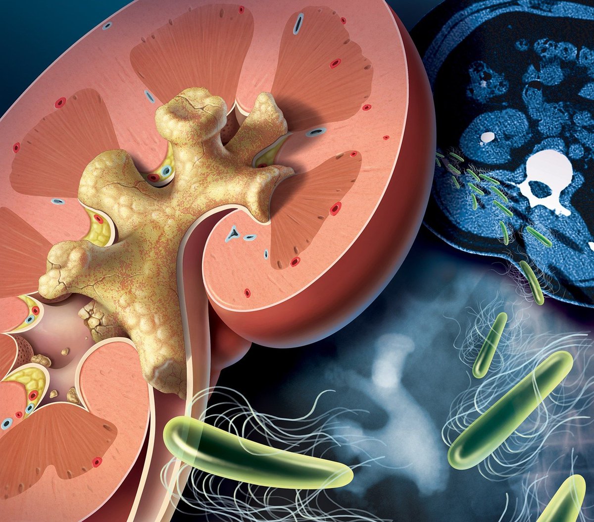 Illustration by Todd Buck of a large staghorn calculus kidney stone. Explore more by Todd: buff.ly/2Bz81pS #kidneystone #urology #bacteria #emergencymedicine #patienteducation #medical #illustration #medicalillustration #medicalillustrator #3D #sciart #science