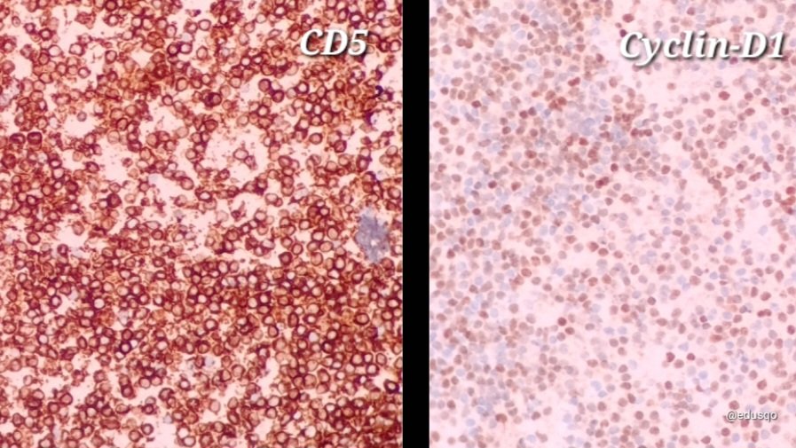 A mantle cell lymphoma for this #FNAFriday:
▫️Agressive B cell lymphoma
▫️Monomorphous small to medium sized lymphoid cell population
     ☝🏽 Blastoid variant
▫️Nuclear contour irregularities
▫️Condensed chromatin
▫️#CellBlock for #IHCPath or flow cytometry
#HemePath #CytoPath