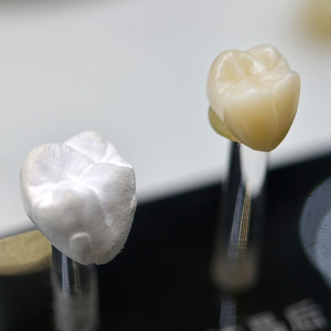 Looking for high-quality dental crowns that blend seamlessly with natural teeth? Our skilled technicians at Reliable Dental Studio specialize in crafting custom crowns for durable and aesthetic smile enhancements.

Learn More: buff.ly/3UB98y3
#ReliableDentalLab #DentalLab