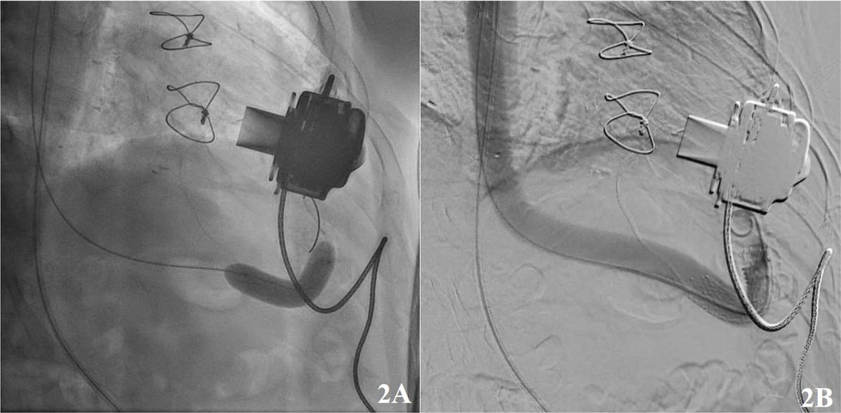 New #DeBakeyCVJournal Case Report! Percutaneous Intervention of LVAD Outflow Graft Obstruction and Thrombosis -Andrew Takla, Fahad Eid, Mostafa Elbanna, Mohamed Magdi Eid, Akshay Joshi, Abdallah Bitar, Ryan Lydon, Scott Feitell doi.org/10.14797/mdcvj… @CardioNerds #cardiotwitter