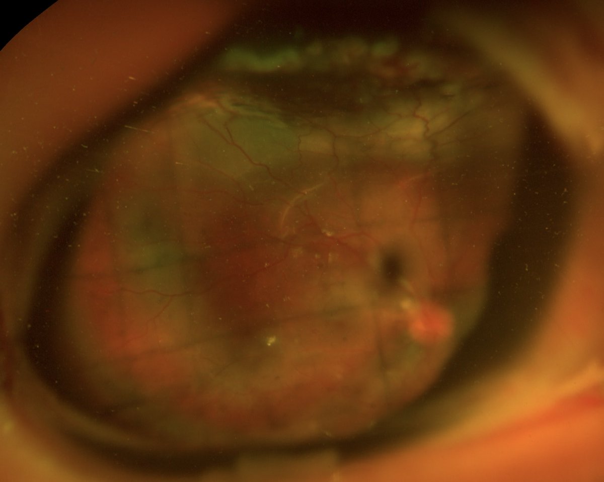 Silicone oil retention sutures, seen through an Optos photo for a post traumatic retinal detachment repair

Successfully keeping the silicone oil in place (aphakia + traumatic aniridia)