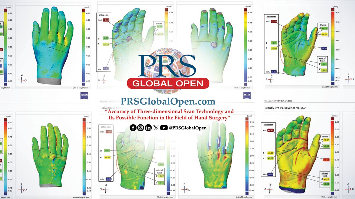 The April 2024 compendium of #PRSGlobalOpen is available NOW! Read articles like 'Accuracy of Three-dimensional Scan Technology and Its Possible Function in the Field of Hand Surgery' by Rudari, Breuer, Lauer, et al: bit.ly/3DHandSurgery