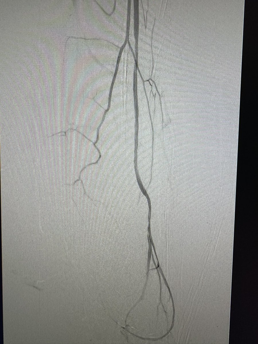 banderaldhafery's tweet image. #CLTI in young diabetic patient ( 42y/o) , Rutherford class 5.
Occluded PTA at the foot.

Successful #Revascularization through #pedal loop technique.

#limb_salvage 
#amputation_prevention 
#IR #endovascular #interventional