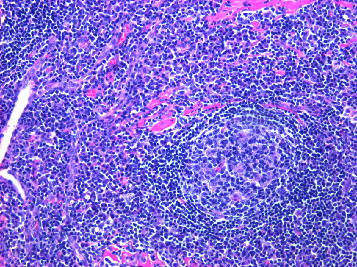 #hemepath Extranodal marginal zone lymphoma of lung, IgG4 positive!