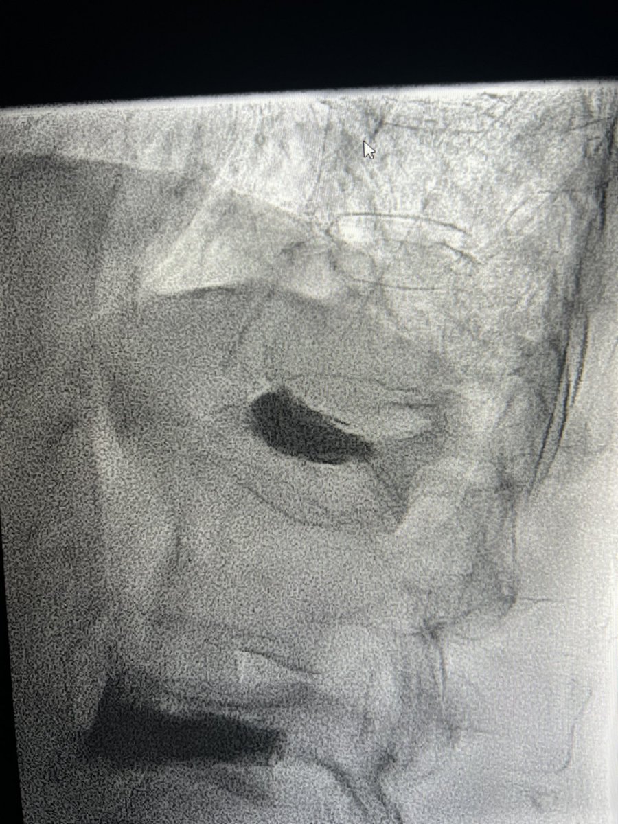 First Spinejack as an attending. Smallest device still got some decent height restoration, patient went from 10/10 to 2/10 next day. #MSKIR #VIRad #kyphoplasty #withoutascalpel