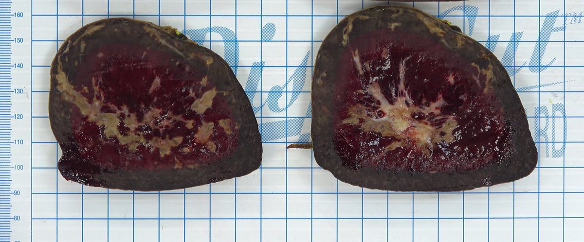 The spleen is an organ with some surprises! Splenectomy for angioma and puf! Gamna Gandy Bodies/nodules! Merit goes to @Joaomgama