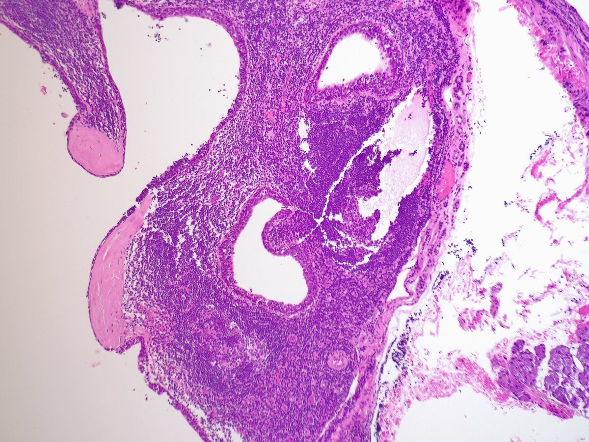 Parotid mass. Completely cystic at 🔪 🔬What's your diagnosis? #PathTwitter #ENTPath #pathresidents