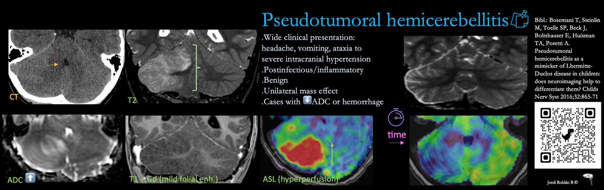 🦓 mimicker: Pseudotumoral hemicerebellitis CT: tricky detection. 🧭look for changes in the IV ventricle -shape, size- MR: tricky diagnosis. 🧭GENERALLY it´s Dr. No❌: no ⬇️ADC, no🩸, no defined mass. No vascular territory Mindset: to be aware of its existence🎯