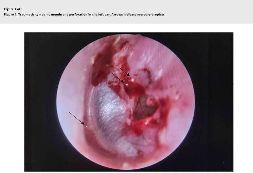 A 37-year-old woman inserted and broke a mercury thermometer in her left ear and experienced ototoxicity from direct inner ear exposure to mercury tandfonline.com/doi/full/10.10…