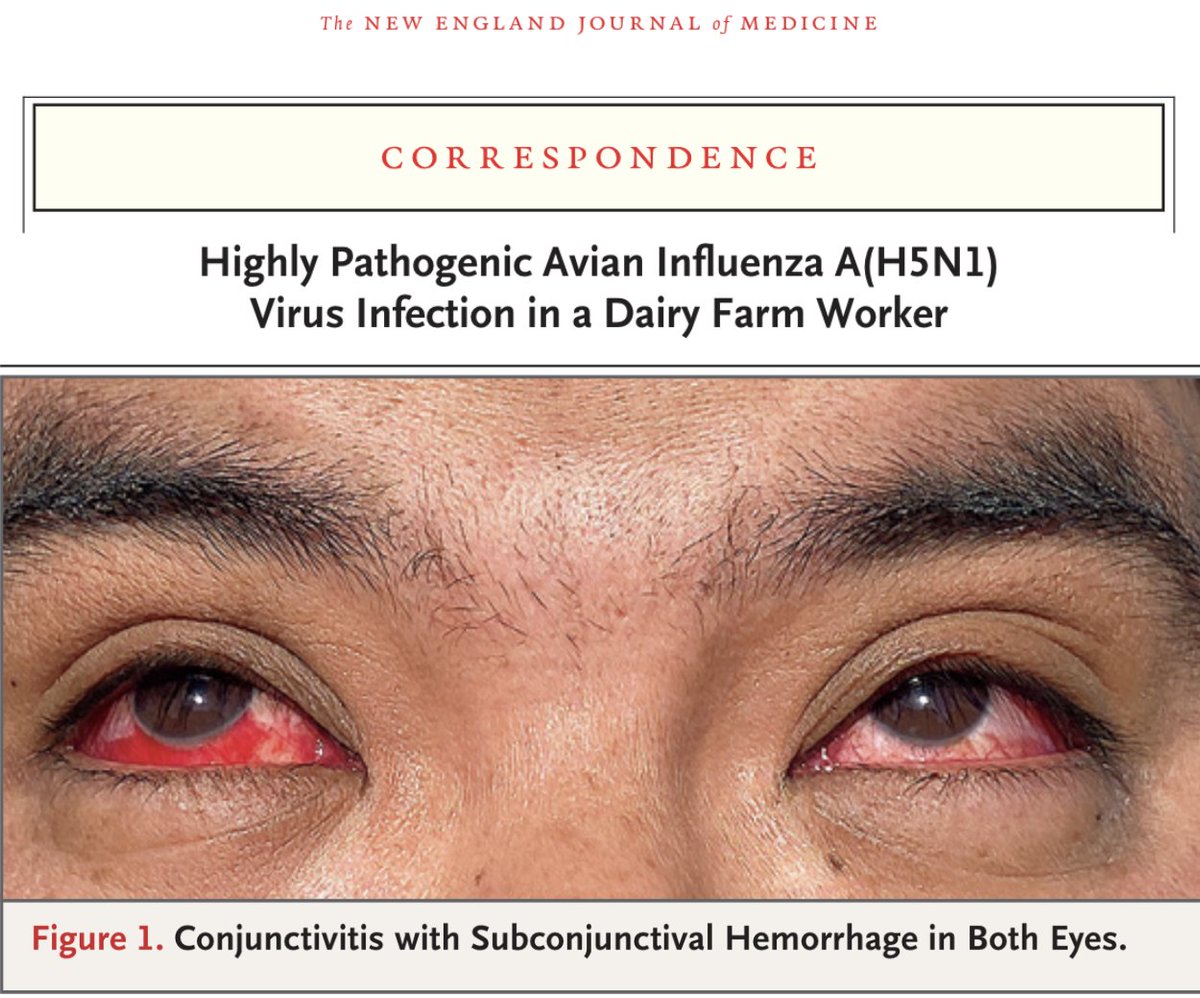 BREAKING - Full case details released of the H5N1 Bird Flu human infection detected in Texas - The patient presented with subconjunctival hemorrhage and right eye drainage with no other symptoms. He was in close contact with dairy cows, indicating cattle-to-human transmission.…