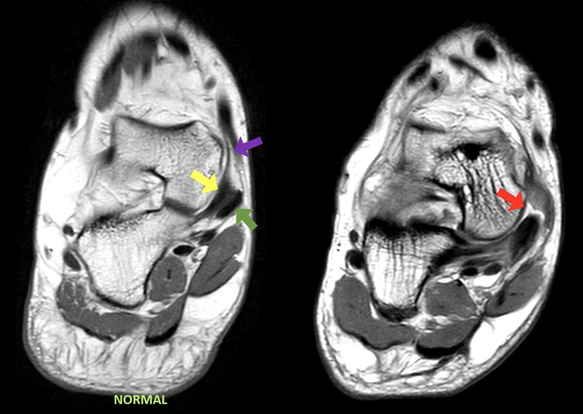 The oblique coronal plane in ankle MRI allows to depict better the superomedial fibers of the spring ligament complex (yellow) as well as the tibiospring ligament (purple) and the tibialis posterior tendon (green). To your right, a SM fibers complete tear (red) #radres #MSK #MRI
