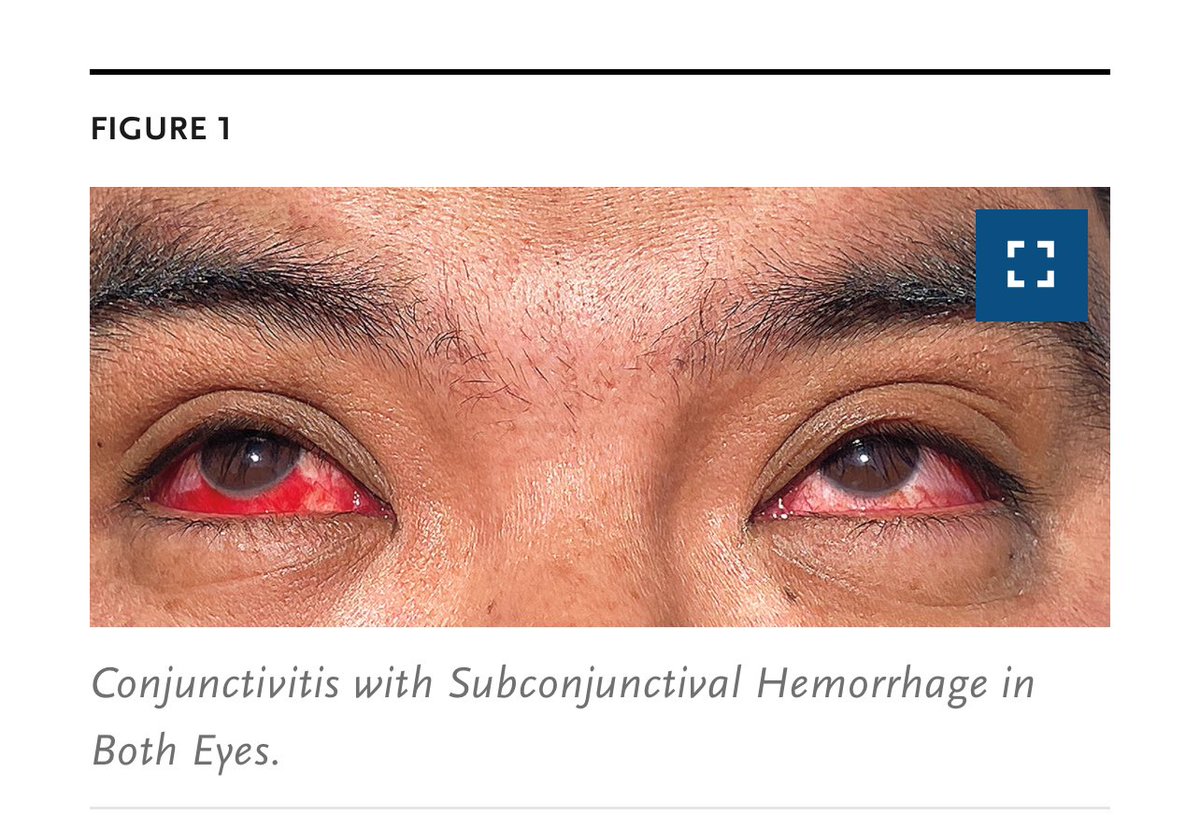 “In late March 2024, an adult dairy farm worker had onset of redness and discomfort in the right eye. On presentation that day, subconjunctival hemorrhage and thin, serous drainage were noted in the right eye…” #H5N1 nejm.org/doi/full/10.10…