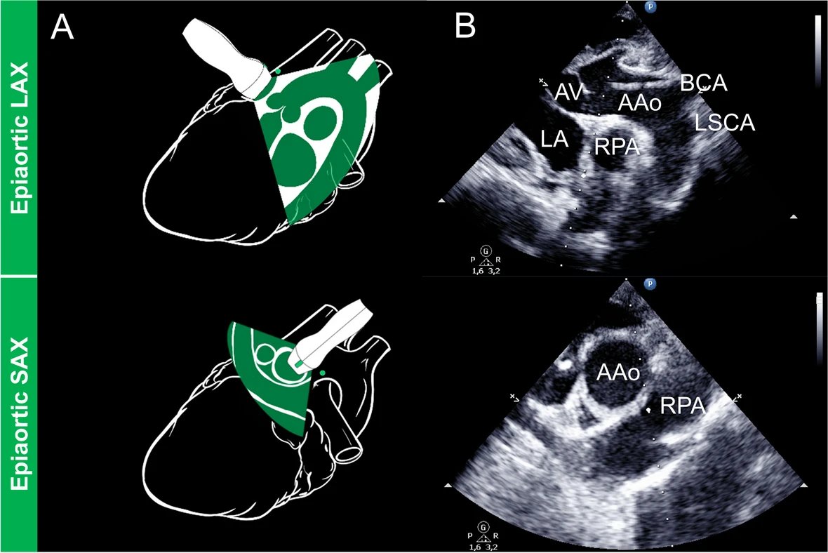 Cardiac dimensions and hemodynamics in healthy juvenile Landrace swine 🐖
Interesting article …ovascularultrasound.biomedcentral.com/articles/10.11…
#echofirst #vetPOCUS #POCUS #MedEd