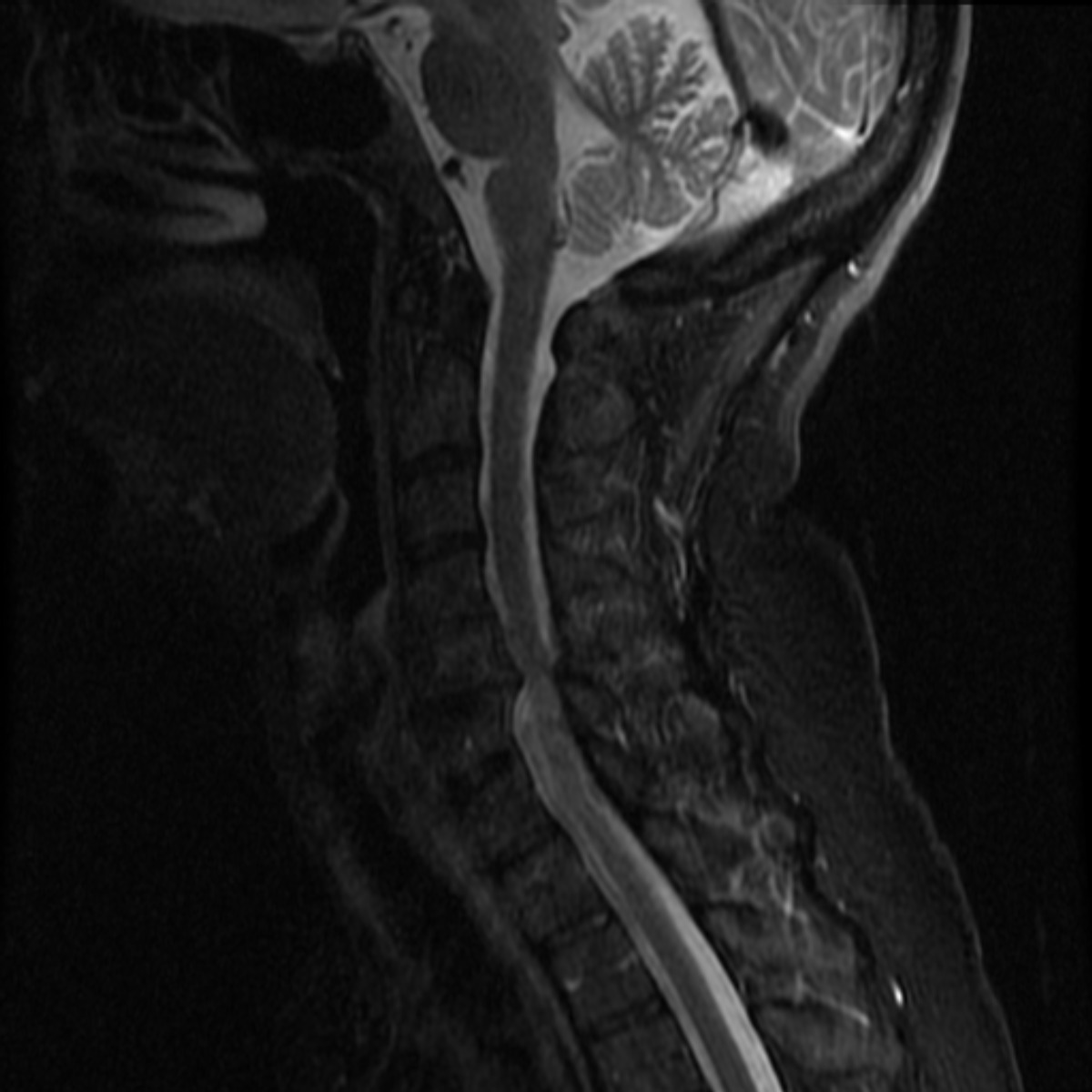 @WoodstockSusie In January we finally figured out what was going on but still, no treatment....

Left- cervical dystonia (oversized muscle stuck in contact mode) causing vagus nerve compression & dysautonomia

Right- cervical myelopathy (compression causing discs to indent spinal cord)